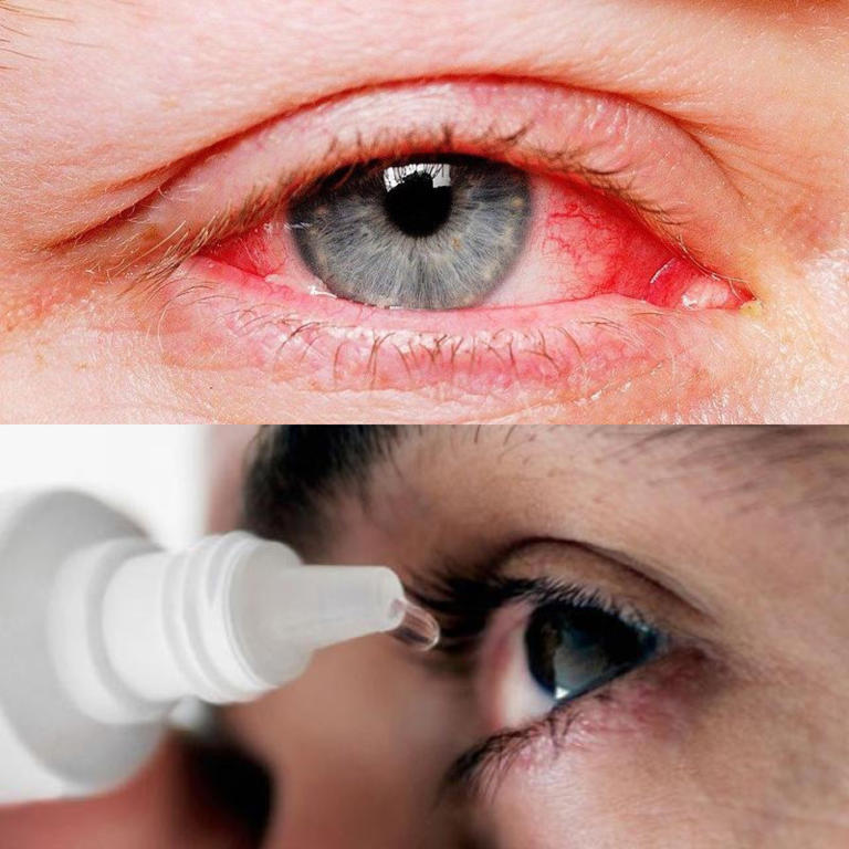 Có những bệnh nhân bị đau mắt đỏ tự mua thuốc về điều trị đã dẫn đến loét giác mạc, tăng nhãn áp, thậm chí sẹo giác mạc làm suy giảm thị lực.